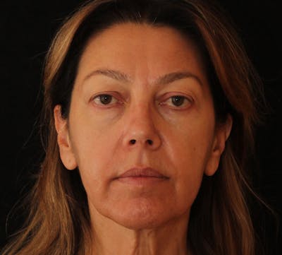 Browlift/Upper Blepharoplasty Before & After Gallery - Patient 242240 - Image 1