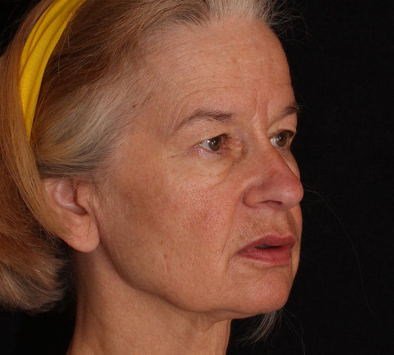 Browlift/Upper Blepharoplasty Before & After Gallery - Patient 368526 - Image 3