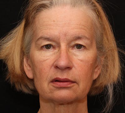 Browlift/Upper Blepharoplasty Before & After Gallery - Patient 368526 - Image 1