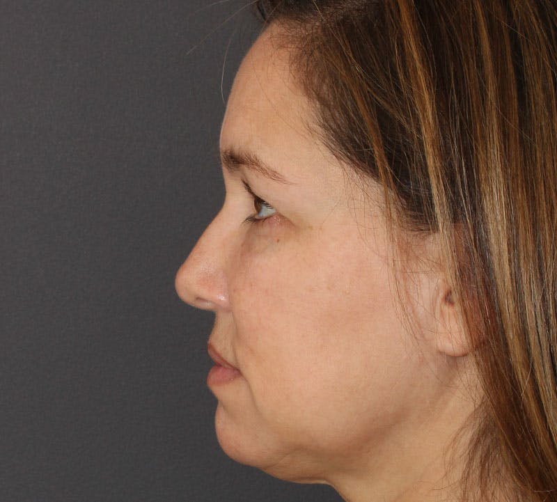 Browlift/Upper Blepharoplasty Before & After Gallery - Patient 424726 - Image 7