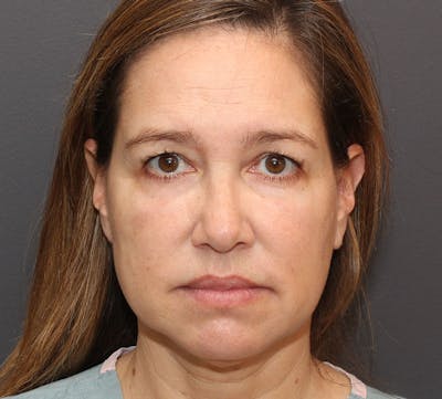 Browlift/Upper Blepharoplasty Before & After Gallery - Patient 424726 - Image 1
