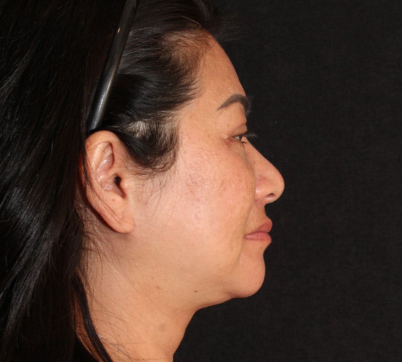 Browlift/Upper Blepharoplasty Before & After Gallery - Patient 368190 - Image 6