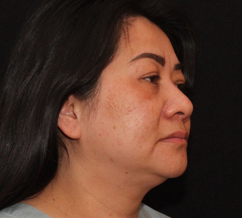 Browlift/Upper Blepharoplasty Before & After Gallery - Patient 368190 - Image 3