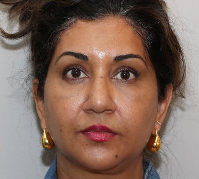 Browlift/Upper Blepharoplasty Before & After Gallery - Patient 217429 - Image 2