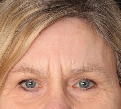 Browlift/Upper Blepharoplasty Before & After Gallery - Patient 471033 - Image 2