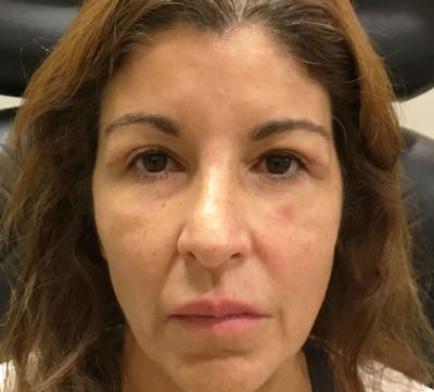 Browlift/Upper Blepharoplasty Before & After Gallery - Patient 242260 - Image 2
