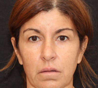 Browlift/Upper Blepharoplasty Before & After Gallery - Patient 242260 - Image 1
