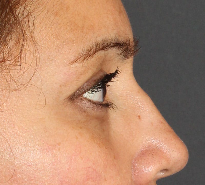 Lower Blepharoplasty Before & After Gallery - Patient 429237 - Image 6