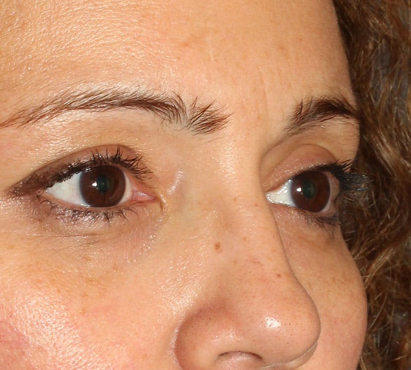 Lower Blepharoplasty Before & After Gallery - Patient 429237 - Image 4
