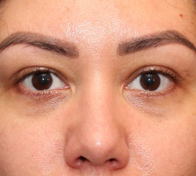 Lower Blepharoplasty Before & After Gallery - Patient 235363 - Image 2