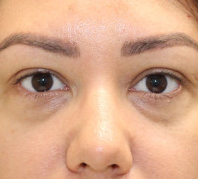 Lower Blepharoplasty Before & After Gallery - Patient 235363 - Image 1