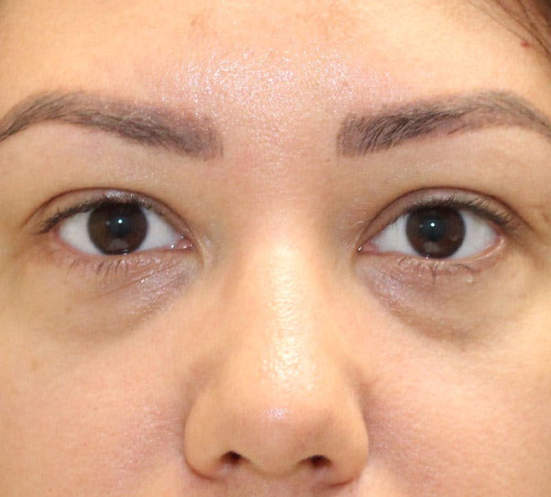 Lower Blepharoplasty Before & After Gallery - Patient 235363 - Image 1
