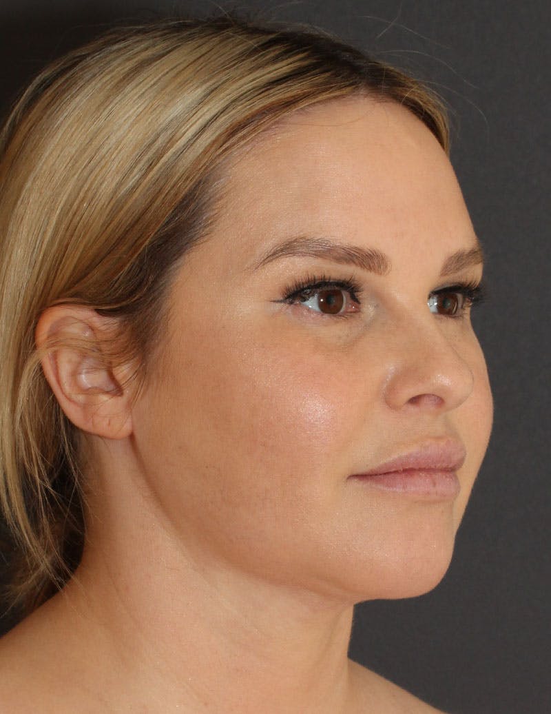 Facetite Before & After Gallery - Patient 910728 - Image 4