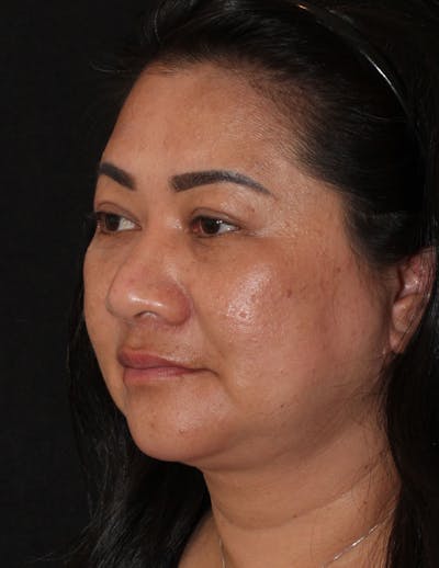 Facetite Before & After Gallery - Patient 402853 - Image 2