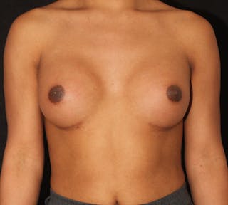 Transgender Breast Augmentation Before & After Gallery - Patient 102977 - Image 2