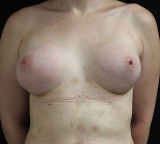 Transgender Breast Augmentation Before & After Gallery - Patient 313397 - Image 2