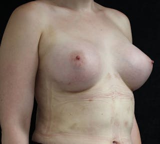 Transgender Breast Augmentation Before & After Gallery - Patient 313397 - Image 4