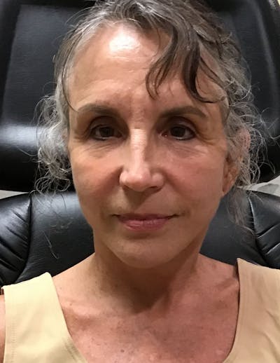 Facelift/Necklift Before & After Gallery - Patient 372418 - Image 2
