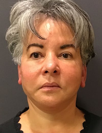 Facelift/Necklift Before & After Gallery - Patient 311382 - Image 2
