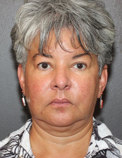 Facelift/Necklift Before & After Gallery - Patient 311382 - Image 1