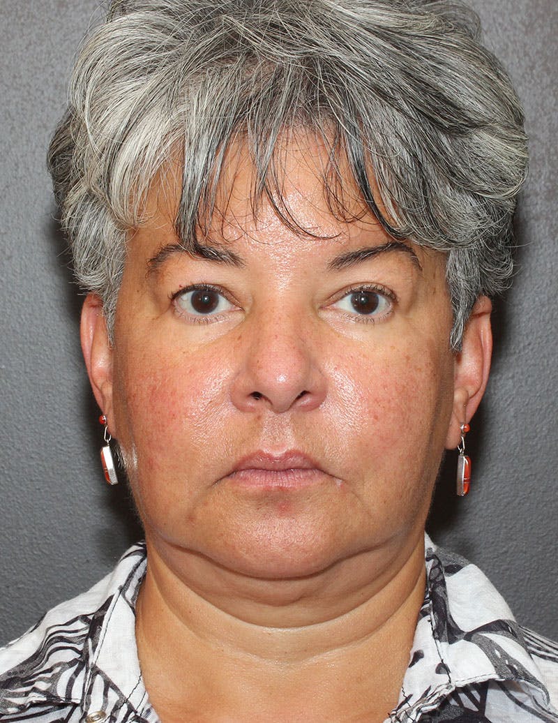 Facelift/Necklift Before & After Gallery - Patient 311382 - Image 1