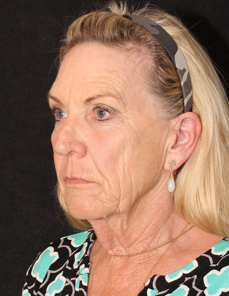 Facelift/Necklift Before & After Gallery - Patient 285509 - Image 10