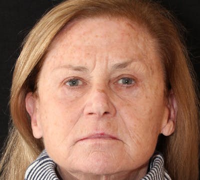 Browlift/Upper Blepharoplasty Before & After Gallery - Patient 136846 - Image 2