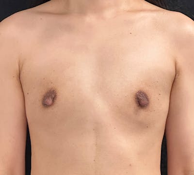 Breast Augmentation Before & After Gallery - Patient 365747 - Image 1