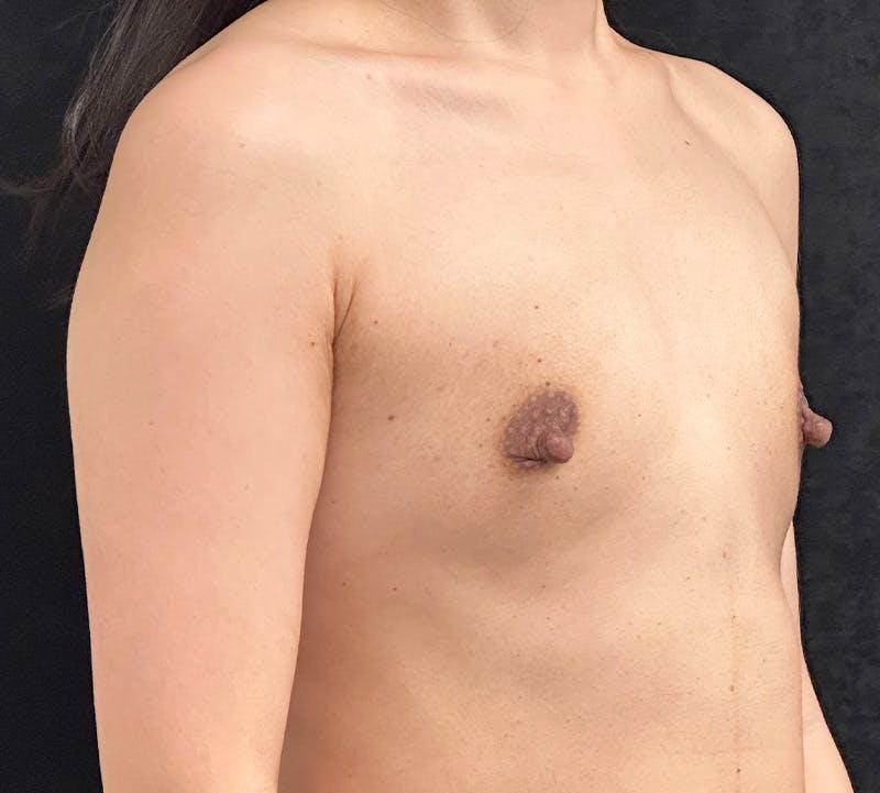 Breast Augmentation Subfascial Before & After Gallery - Patient 237677 - Image 3