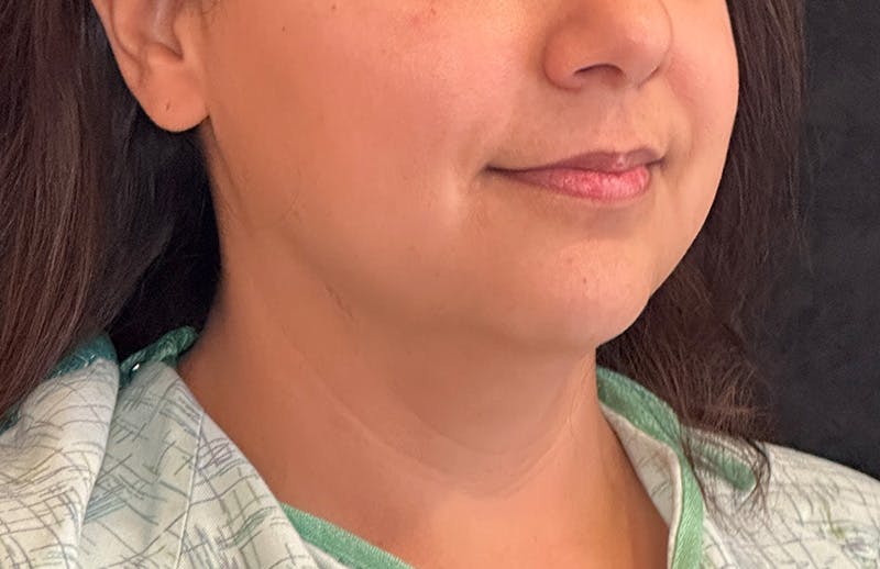 MyEllevate Before & After Gallery - Patient 298575 - Image 3