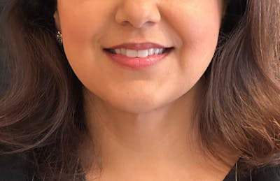 MyEllevate Before & After Gallery - Patient 298575 - Image 2