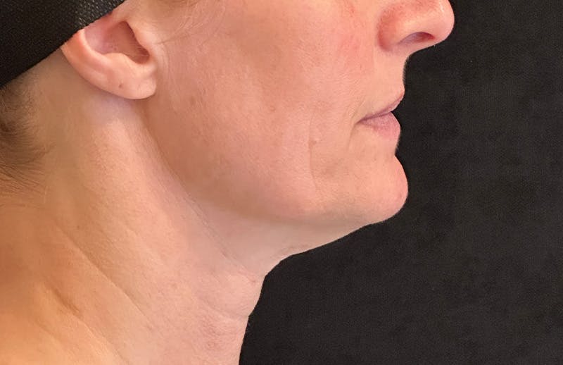 MyEllevate Before & After Gallery - Patient 882823 - Image 5