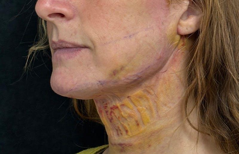 MyEllevate Before & After Gallery - Patient 882823 - Image 8