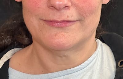 MyEllevate Before & After Gallery - Patient 817655 - Image 1