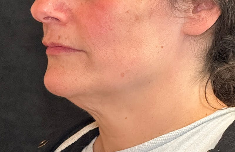 MyEllevate Before & After Gallery - Patient 817655 - Image 7