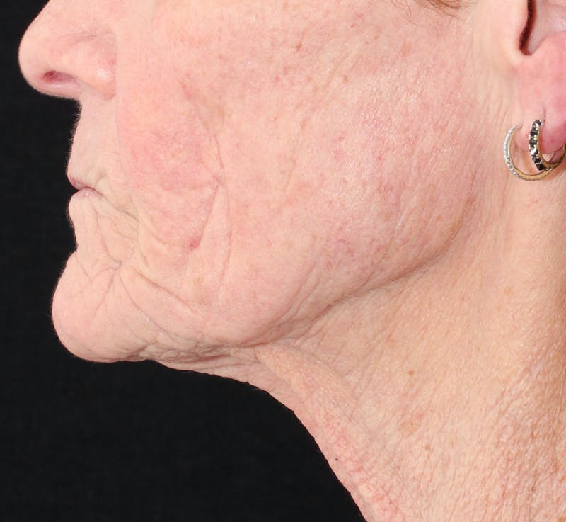 Ellacor Before & After Gallery - Patient 765835 - Image 4