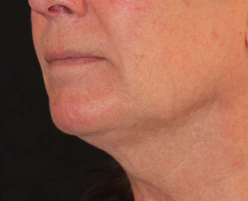 Ellacor Before & After Gallery - Patient 296696 - Image 1