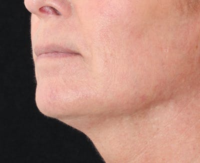 Ellacor Before & After Gallery - Patient 296696 - Image 2