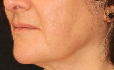 Ellacor Before & After Gallery - Patient 662764 - Image 2