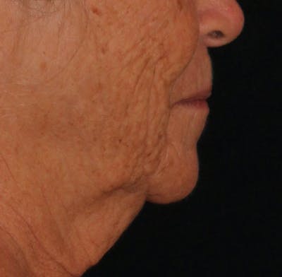 Ellacor Before & After Gallery - Patient 156190 - Image 1