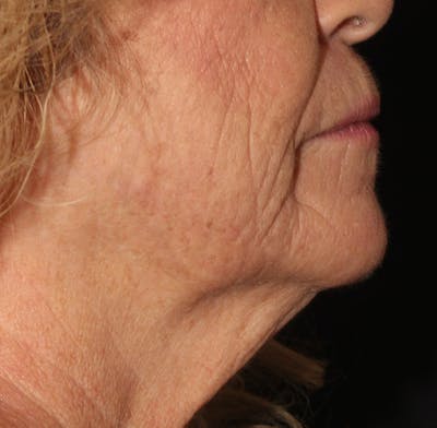 Ellacor Before & After Gallery - Patient 156190 - Image 2