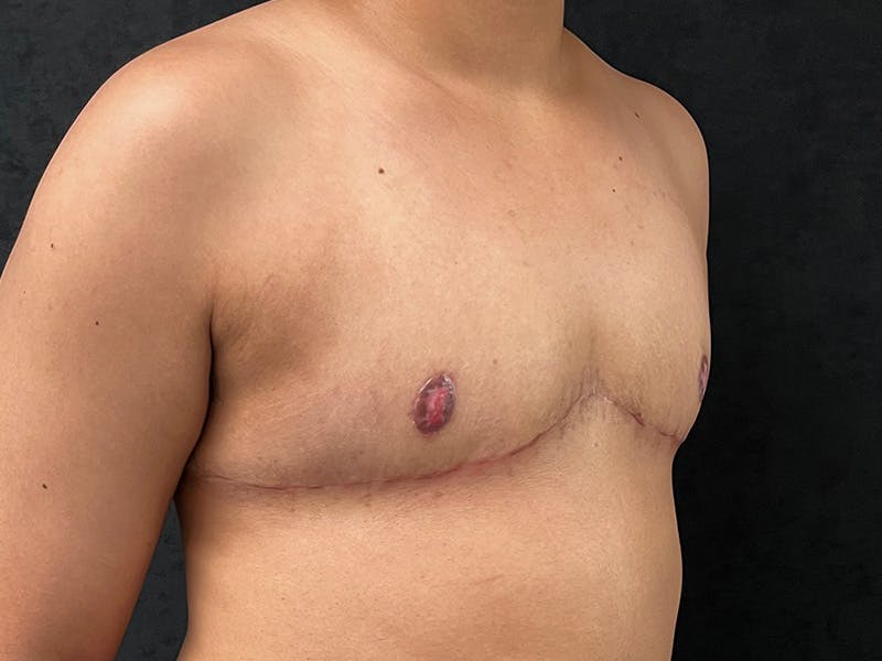 Transgender Top Surgery Before & After Gallery - Patient 935698 - Image 4