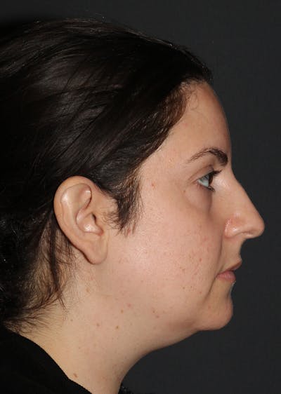 Facetite Before & After Gallery - Patient 424639 - Image 1