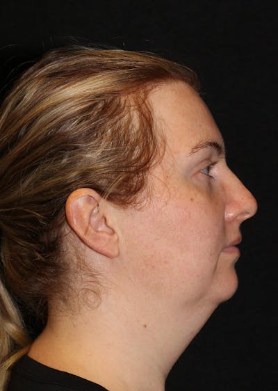 Facetite Before & After Gallery - Patient 225350 - Image 1