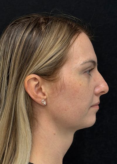 Facetite Before & After Gallery - Patient 225350 - Image 2
