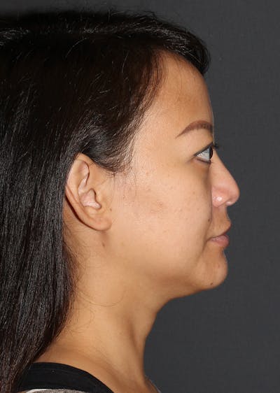 Facetite Before & After Gallery - Patient 331235 - Image 1