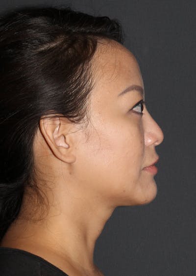 Facetite Before & After Gallery - Patient 331235 - Image 2