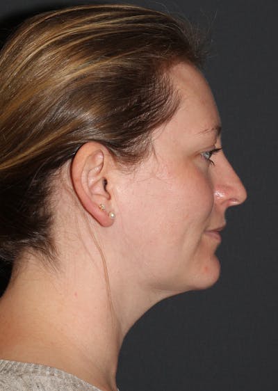 Facetite Before & After Gallery - Patient 149977 - Image 2