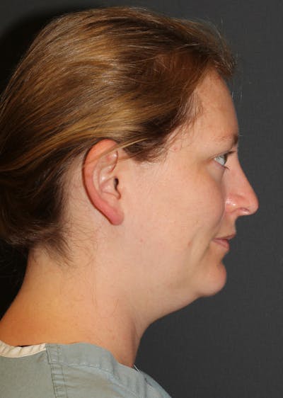 Facetite Before & After Gallery - Patient 149977 - Image 1