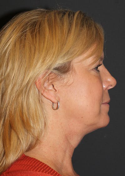 Facetite Before & After Gallery - Patient 300139 - Image 2